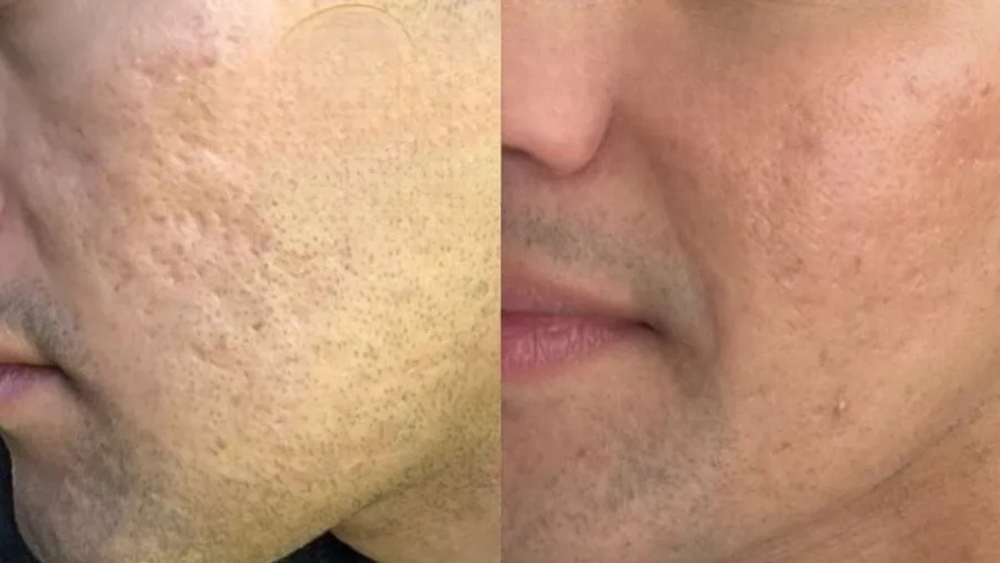 Microneedling+before+and+after