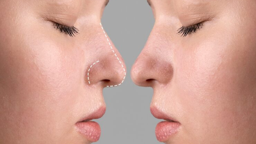 Microneedling+before+and+after+(2)