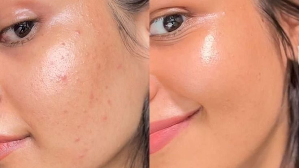 Microneedling+before+and+after+(3)