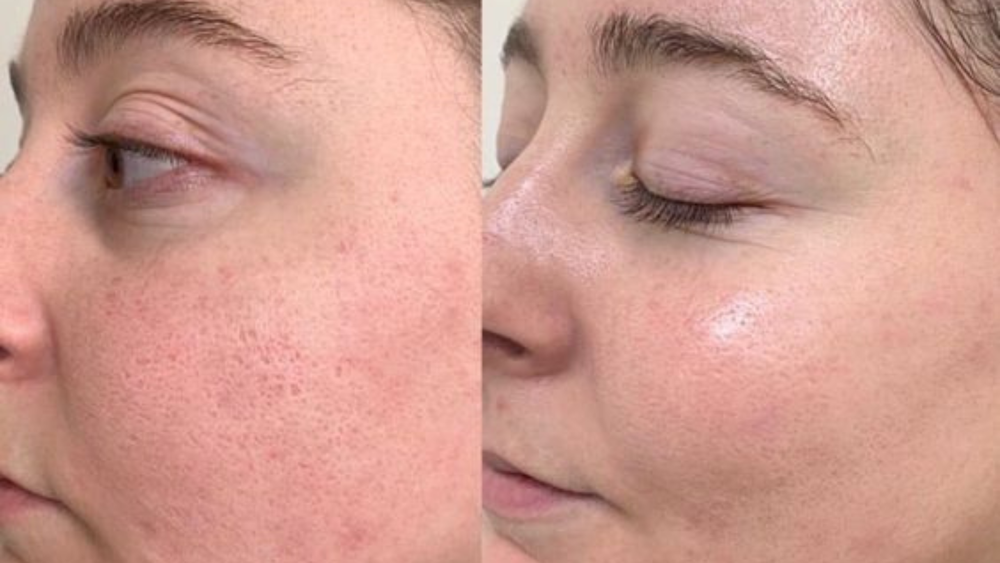 Microneedling+before+and+after+(5)