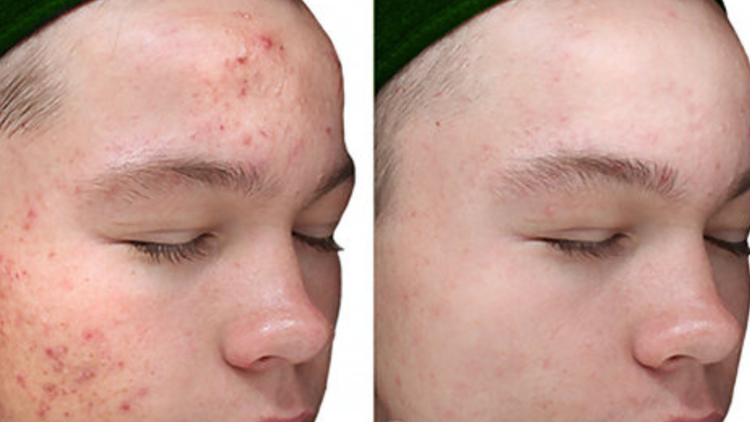 VI+Peel+Treatment+(3)