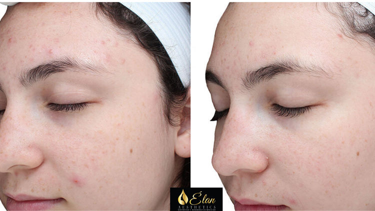 VI+Peel+Treatment+(4)