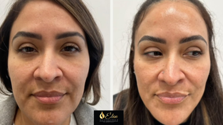 VI+Peel+Treatment+(6)