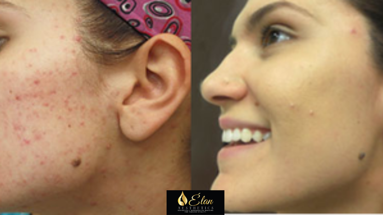 VI+Peel+Treatment+(7)